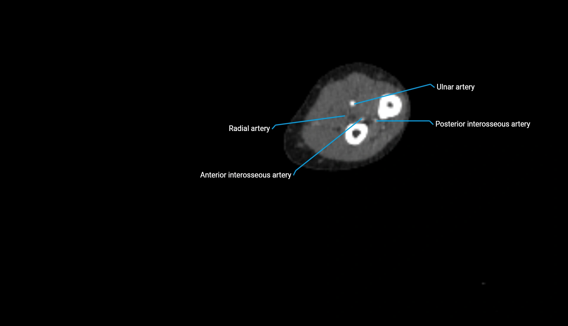 CTA upper limb axial cross sectional anatomy labelled image 158 (2).webp
